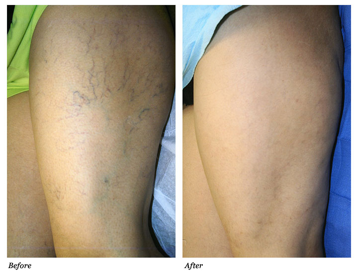 Sclerotherapy Vein Treatment - The Cardiovascular Institute: Vein